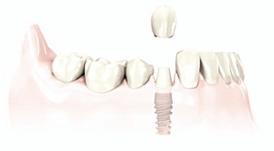 dental-implant