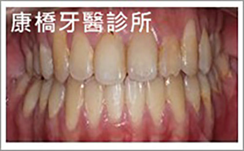 Read more about the article 齒列矯正│陳同學