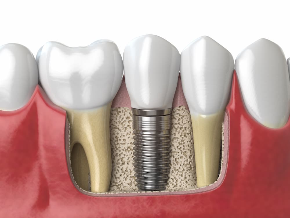 補骨粉手術是什麼？植牙一定要補骨粉嗎？